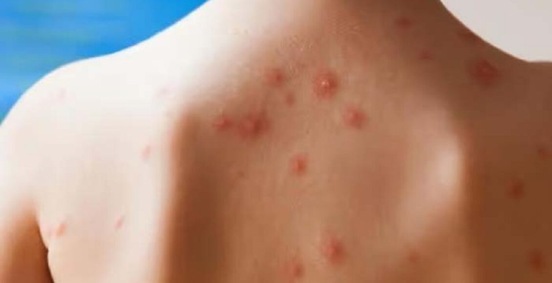 ذرائع وزارت صحت کے مطابق ملک میں رواں برس 16ہزار سے زائد مشتبہ کیسز رپورٹ ہوئے جن میں سے4 ہزار کیس کی تصدیق ہوئی ہے۔